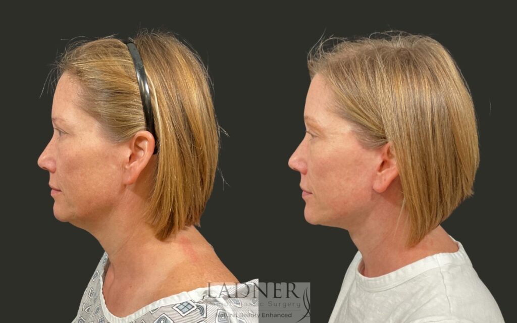 Before and After Image: Deep Plane Lower Facelift/Necklift - left-side