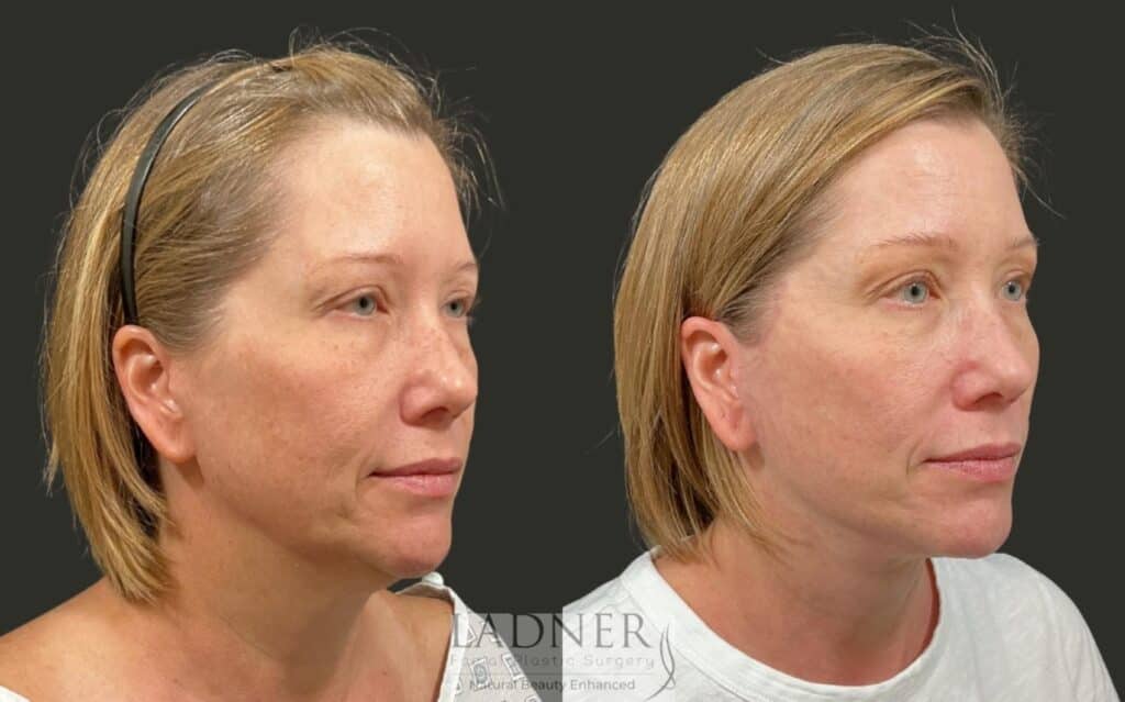 Before and After Image: Deep Plane Lower Facelift/Necklift - right-front-oblique