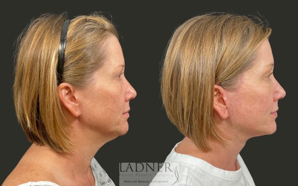 Before and After Image: Deep Plane Lower Facelift/Necklift - right-side