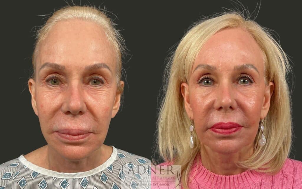 Before and After Image: Brow Lift, Facial Fat Transfer, Lower Eyelid Skin Pinch - front
