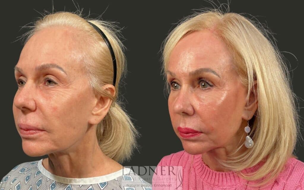 Before and After Image: Brow Lift, Facial Fat Transfer, Lower Eyelid Skin Pinch - left-front-oblique