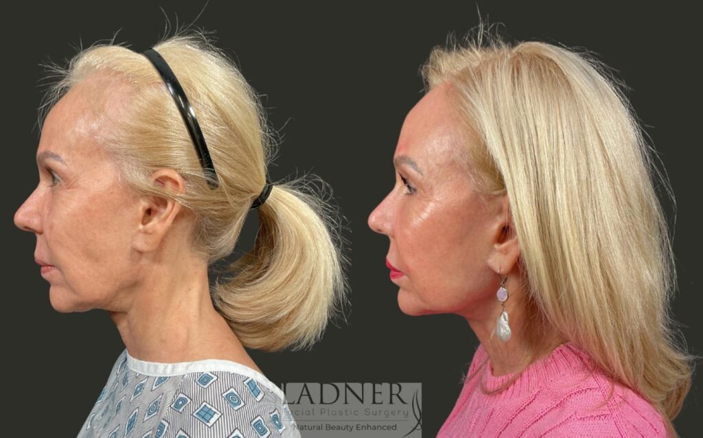 Before and After Image: Brow Lift, Facial Fat Transfer, Lower Eyelid Skin Pinch - left-side