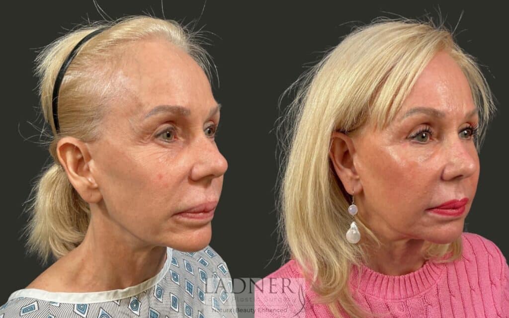 Before and After Image: Brow Lift, Facial Fat Transfer, Lower Eyelid Skin Pinch - right-front-oblique