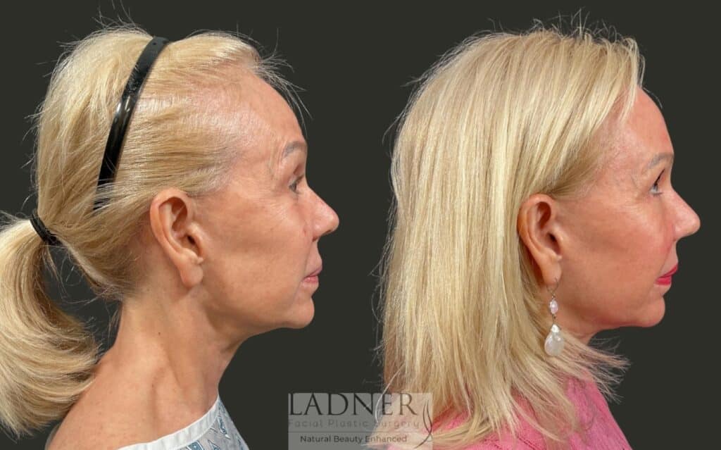 Before and After Image: Brow Lift, Facial Fat Transfer, Lower Eyelid Skin Pinch - right-side
