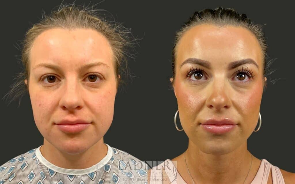 Before and After Image: Minimally Invasive Neck Tightening - front