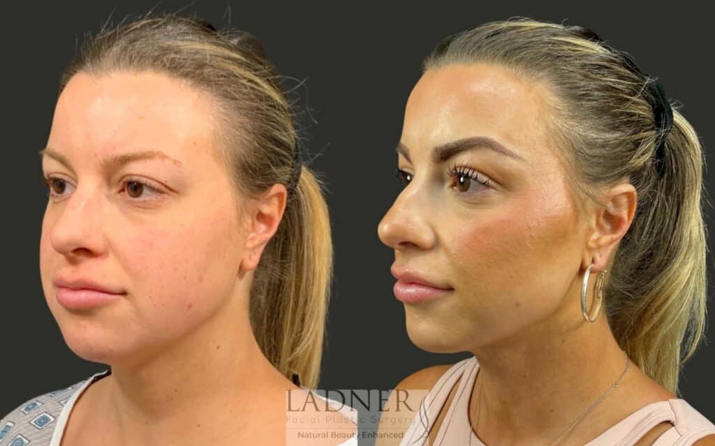 Before and After Image: Minimally Invasive Neck Tightening - left-front-oblique