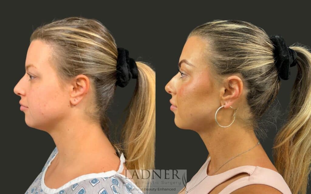 Before and After Image: Minimally Invasive Neck Tightening - left-side
