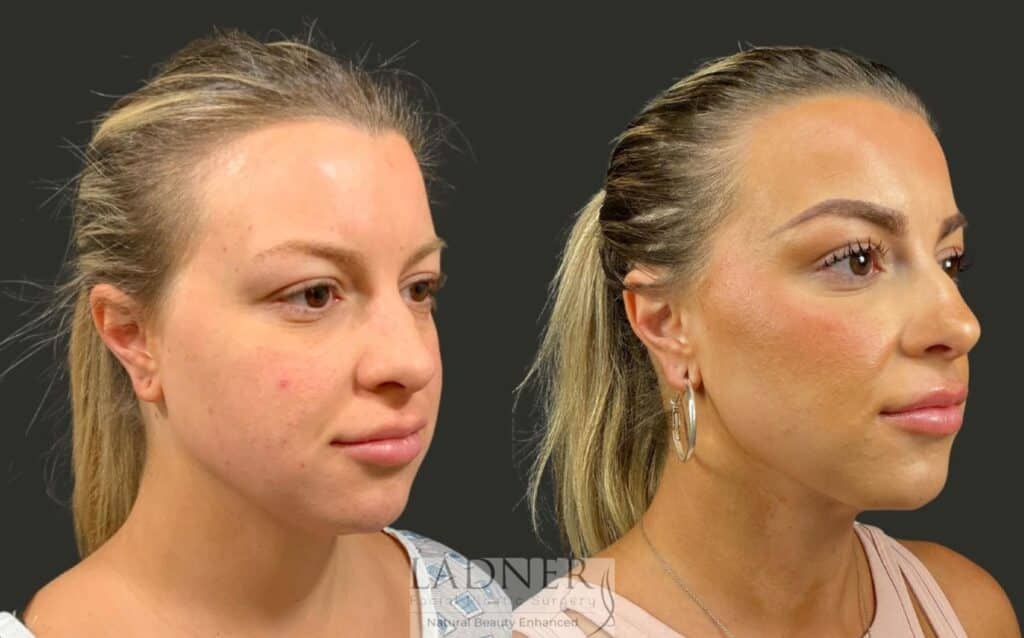 Before and After Image: Minimally Invasive Neck Tightening - right-front-oblique
