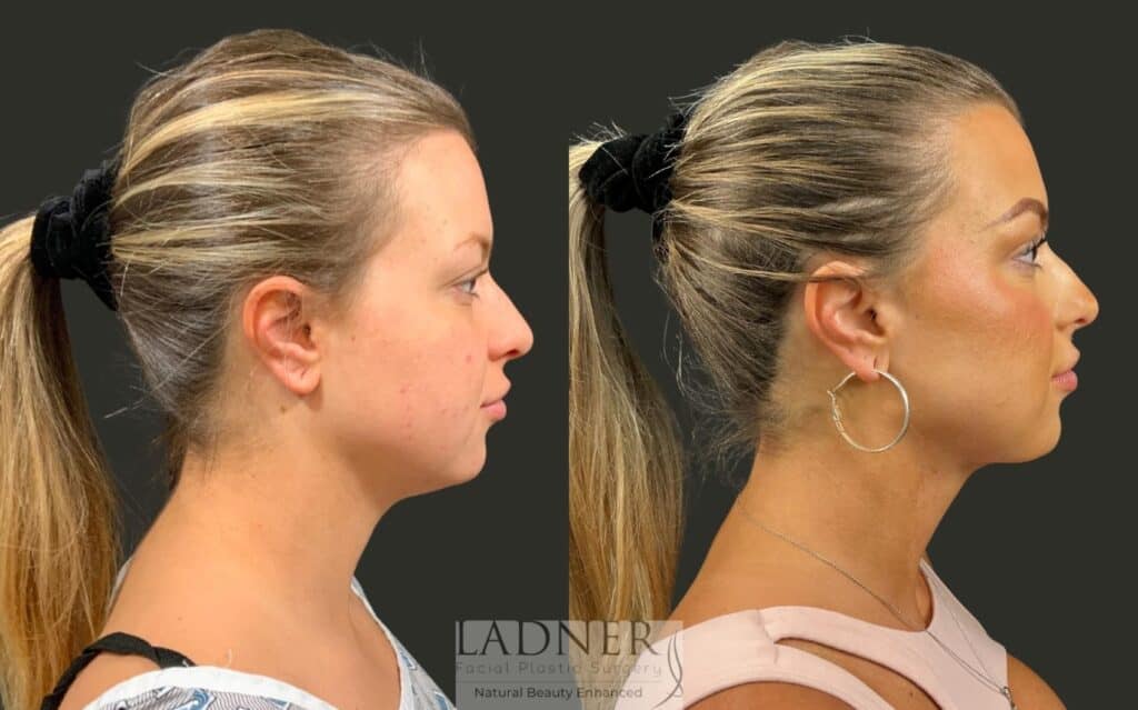 Before and After Image: Minimally Invasive Neck Tightening - right-side
