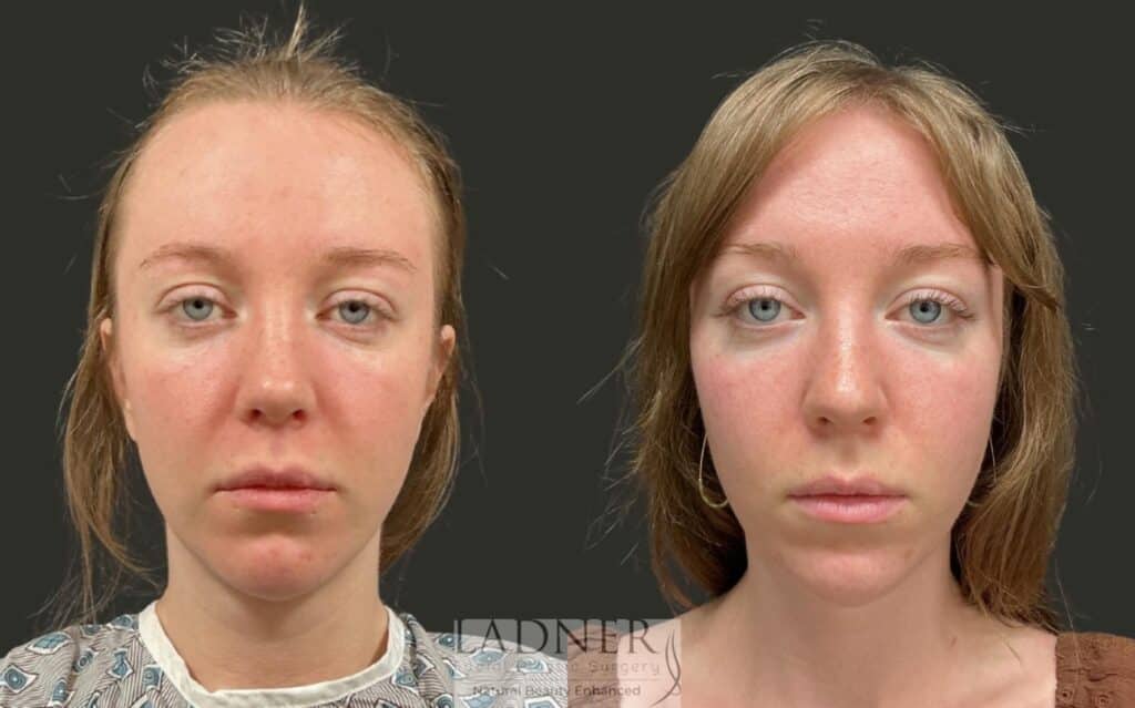 Before and After Image: Brow Lift - front