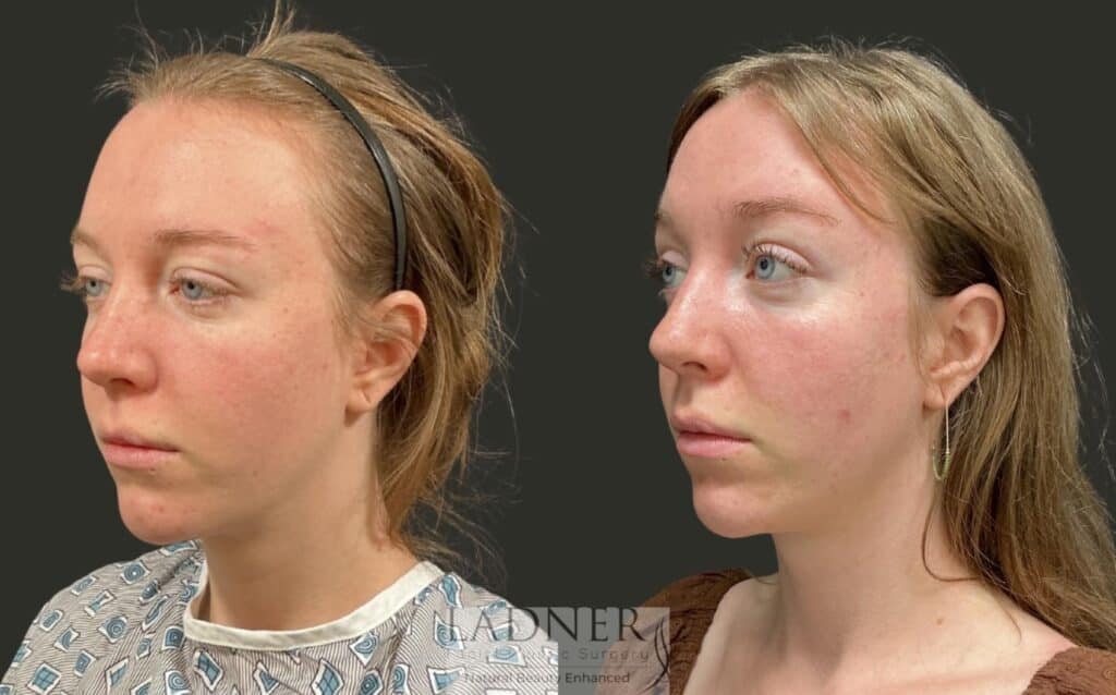 Before and After Image: Brow Lift - left-front-oblique