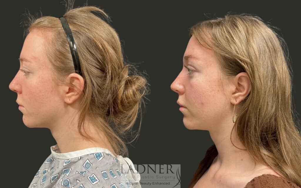 Before and After Image: Brow Lift - left-side