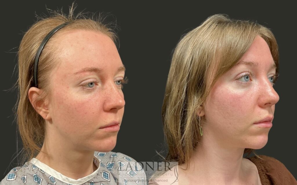 Before and After Image: Brow Lift - right-front-oblique