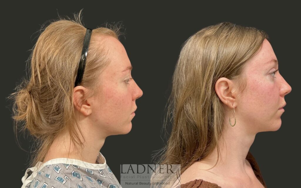 Before and After Image: Brow Lift - right-side
