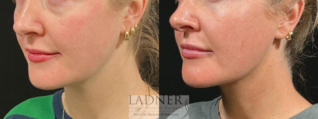 Before and After Image: MINT (Minimally Invasive Neck Tightening) - left-front-oblique
