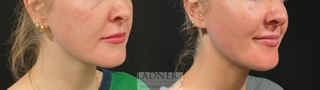Before and After Image: MINT (Minimally Invasive Neck Tightening) - right-front-oblique