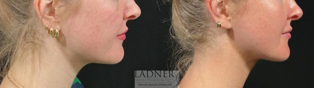 Before and After Image: MINT (Minimally Invasive Neck Tightening) - right-side
