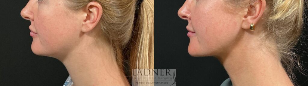 Before and After Image: MINT (Minimally Invasive Neck Tightening) - left-side
