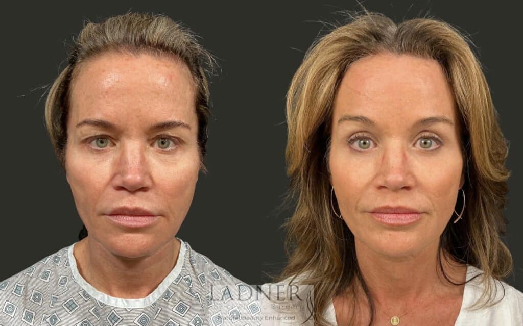 Before and After Image: Brow Lift - front