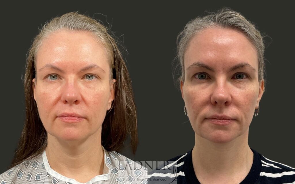 Before and After Image: Neck Lift - front