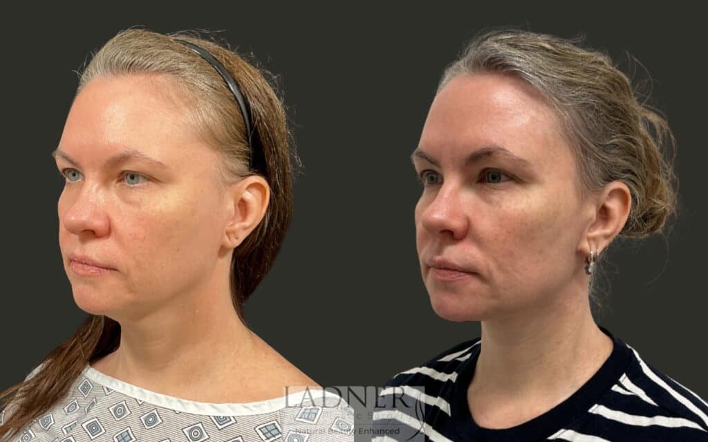 Before and After Image: Neck Lift - left-front-oblique