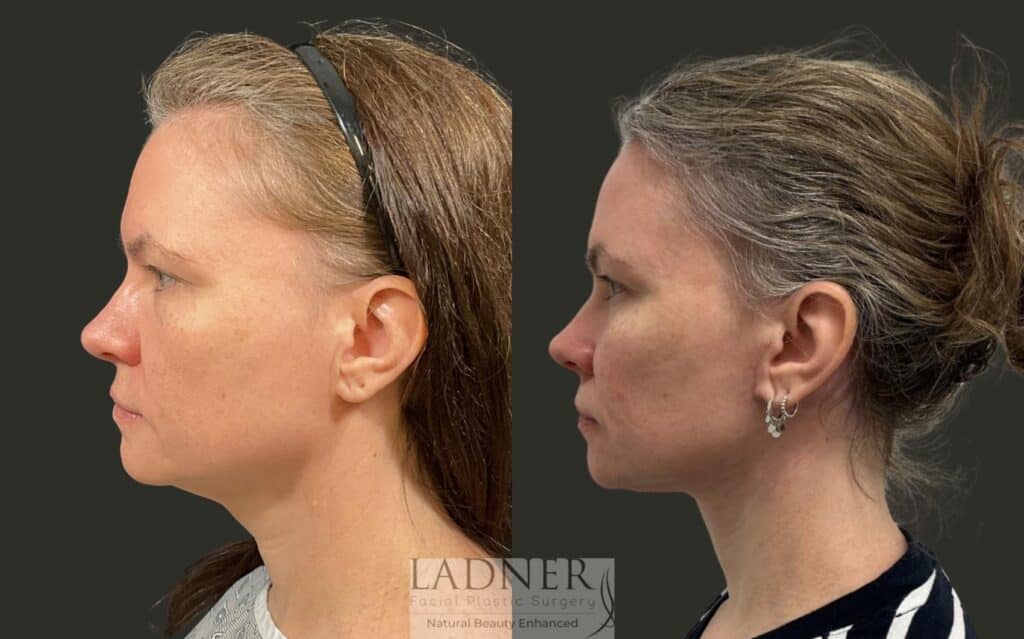 Before and After Image: Neck Lift - left-side