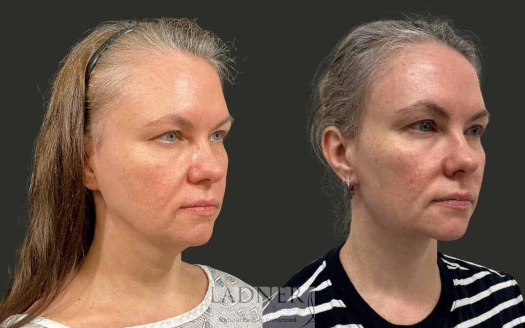 Before and After Image: Neck Lift - right-front-oblique