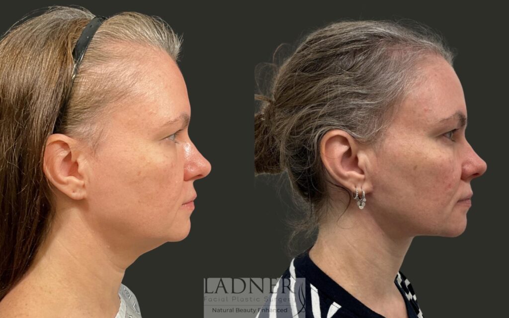 Before and After Image: Neck Lift - right-side