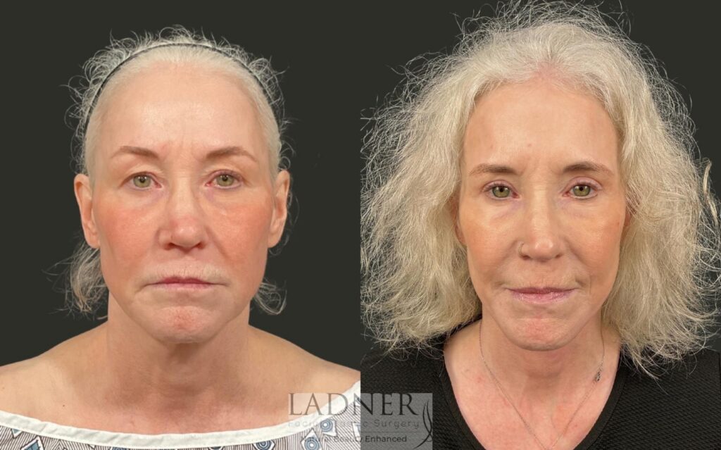 Before and After Image: Ladner Lift, Upper Blepharoplasty, CO2 Laser Resurfacing, Fat Grafting - front