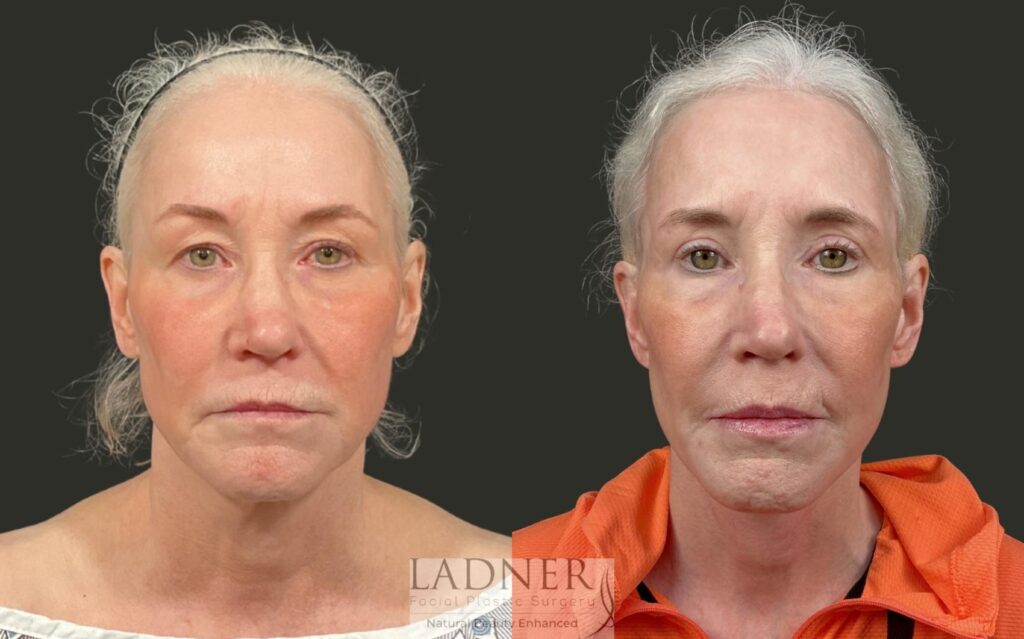 Before and After Image: Ladner Lift, Upper Blepharoplasty, CO2 Laser Resurfacing, Fat Grafting - front