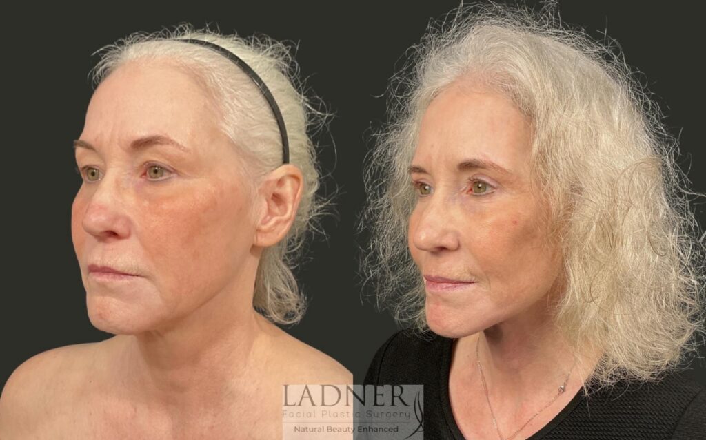 Before and After Image: Ladner Lift, Upper Blepharoplasty, CO2 Laser Resurfacing, Fat Grafting - left-front-oblique