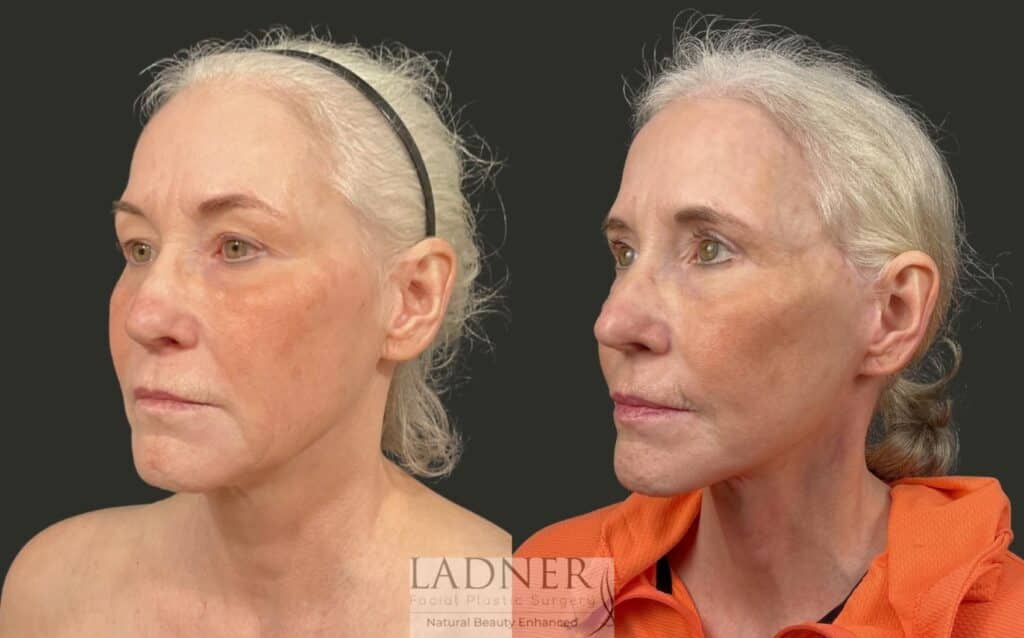 Before and After Image: Ladner Lift, Upper Blepharoplasty, CO2 Laser Resurfacing, Fat Grafting - left-front-oblique