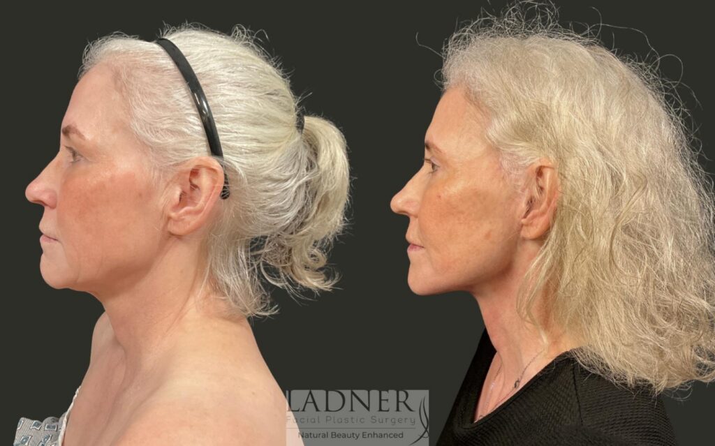 Before and After Image: Ladner Lift, Upper Blepharoplasty, CO2 Laser Resurfacing, Fat Grafting - left-side