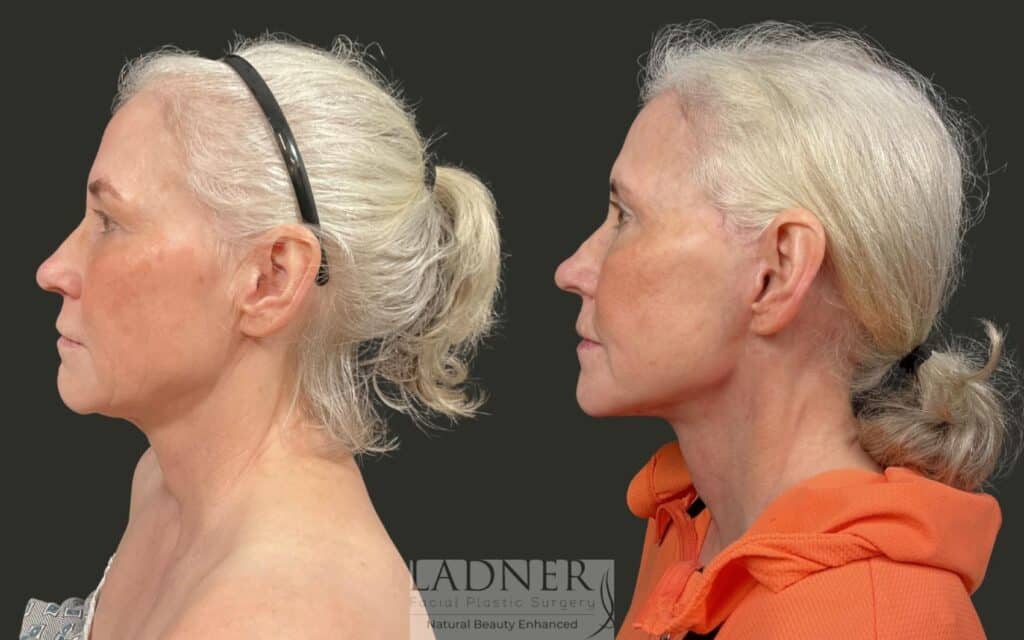 Before and After Image: Ladner Lift, Upper Blepharoplasty, CO2 Laser Resurfacing, Fat Grafting - left-side