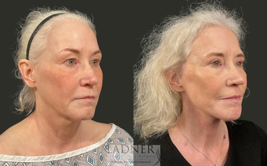 Before and After Image: Ladner Lift, Upper Blepharoplasty, CO2 Laser Resurfacing, Fat Grafting - right-front-oblique