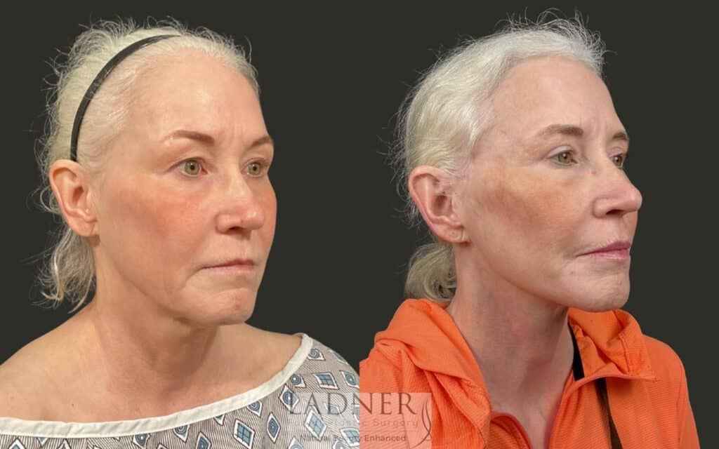 Before and After Image: Ladner Lift, Upper Blepharoplasty, CO2 Laser Resurfacing, Fat Grafting - right-front-oblique
