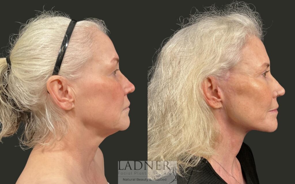 Before and After Image: Ladner Lift, Upper Blepharoplasty, CO2 Laser Resurfacing, Fat Grafting - right-side