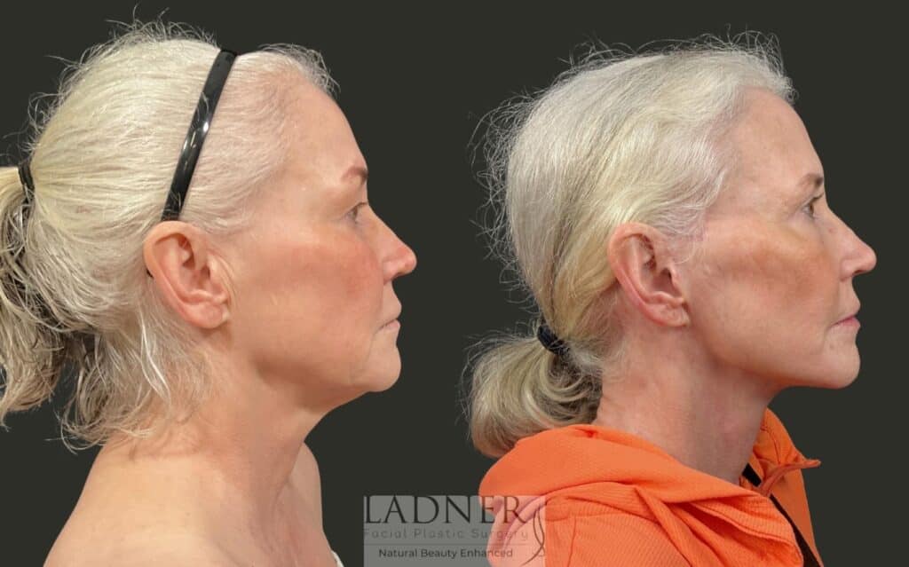 Before and After Image: Ladner Lift, Upper Blepharoplasty, CO2 Laser Resurfacing, Fat Grafting - right-side