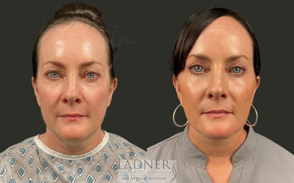 Before and After Image: Deep Plane Neck Lift, Upper Blepharoplasty - front