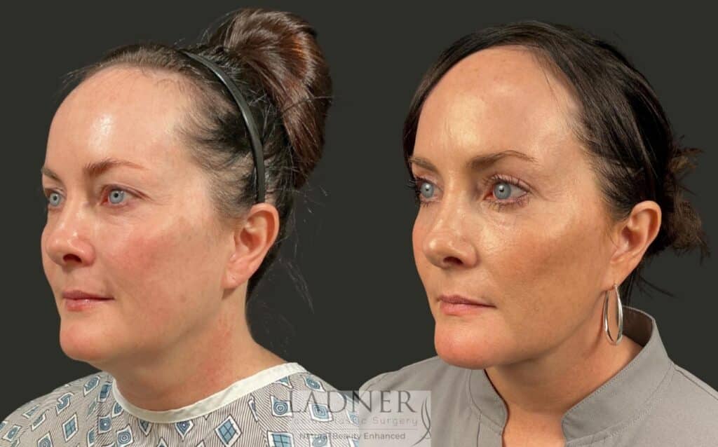 Before and After Image: Deep Plane Neck Lift, Upper Blepharoplasty - left-front-oblique