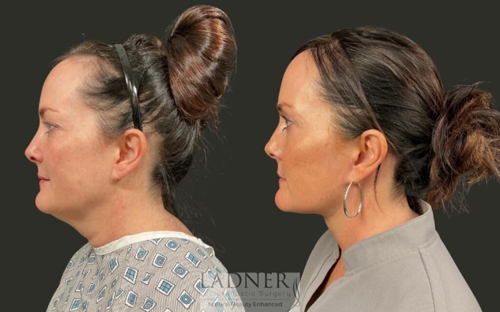 Before and After Image: Deep Plane Neck Lift, Upper Blepharoplasty - left-side