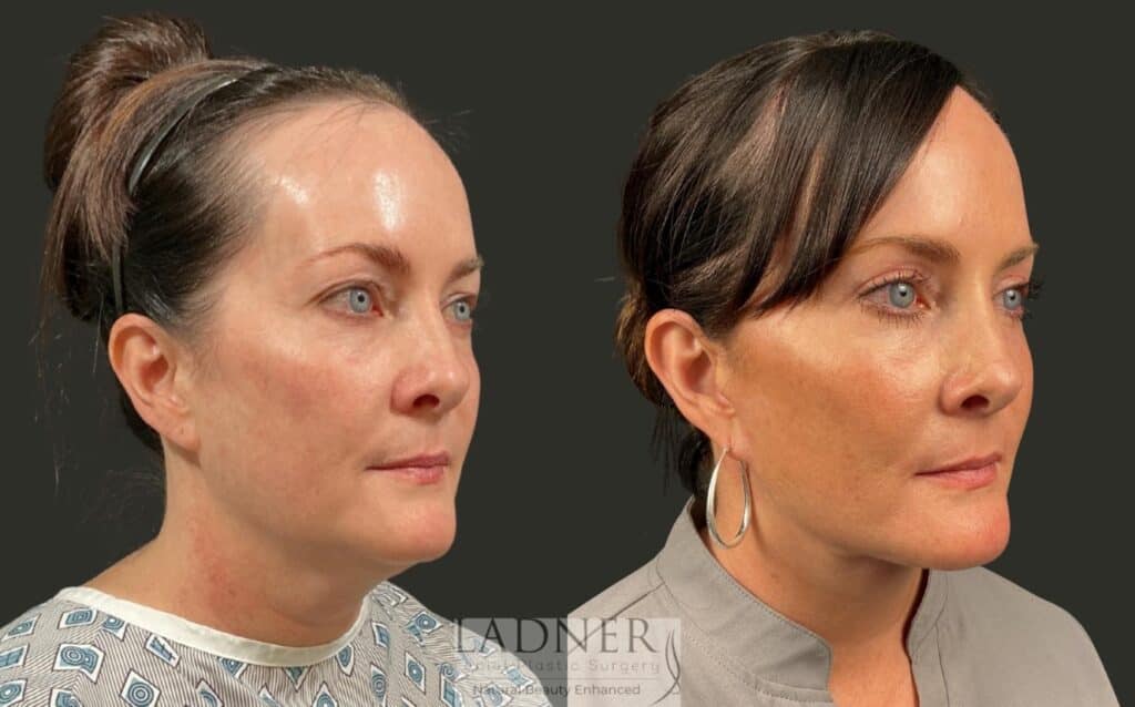 Before and After Image: Deep Plane Neck Lift, Upper Blepharoplasty - right-front-oblique