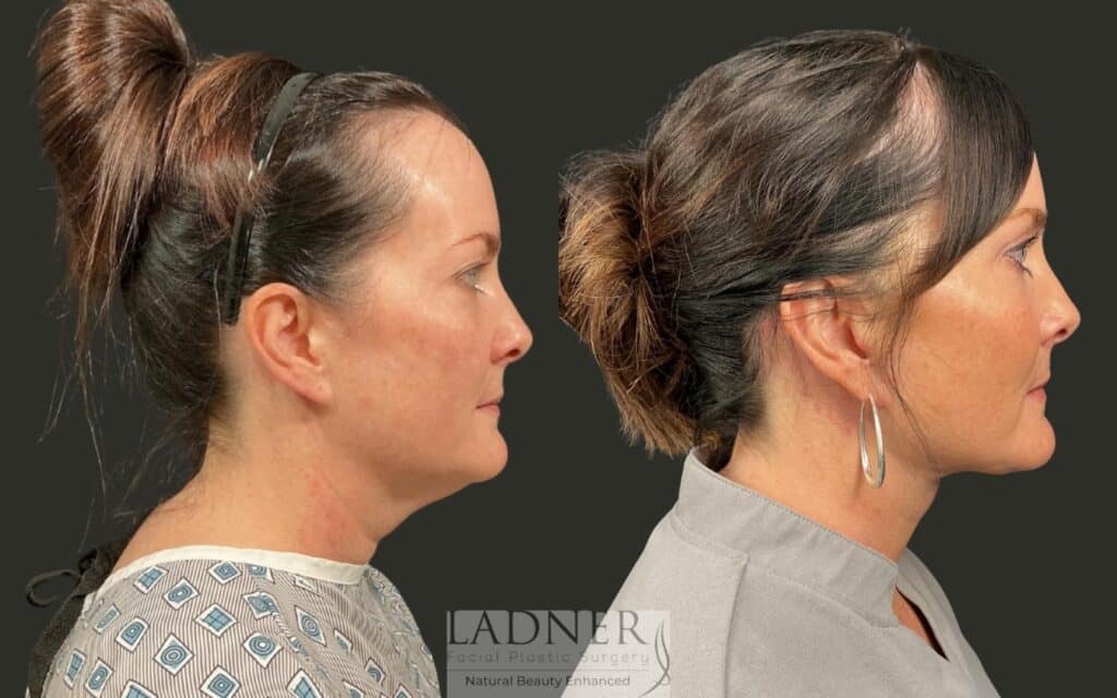Before and After Image: Deep Plane Neck Lift, Upper Blepharoplasty - right-side