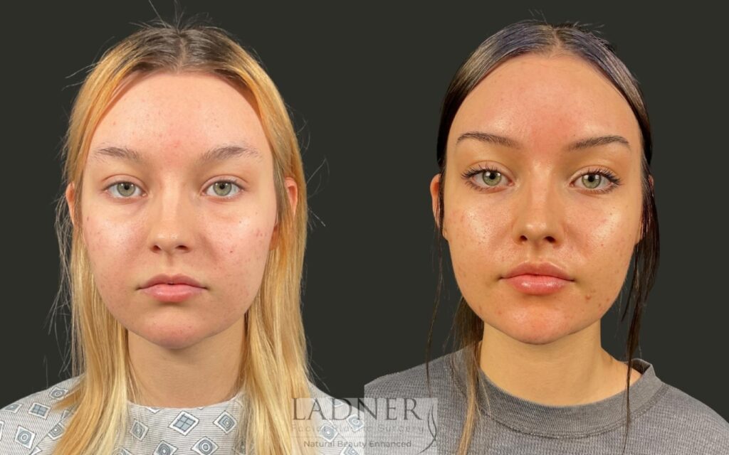 Before and After Image: Lip Lift - front