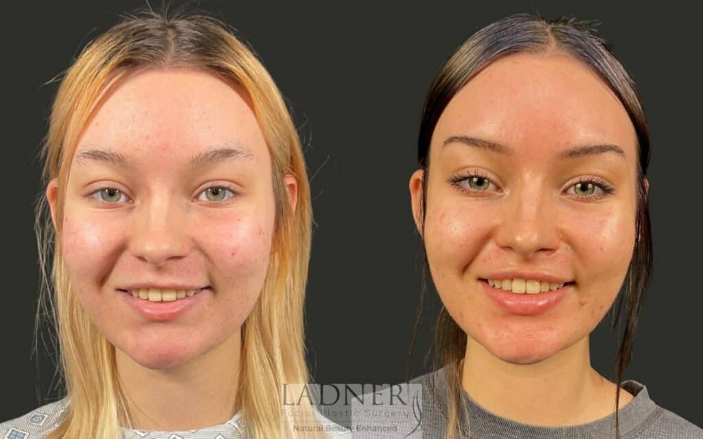 Before and After Image: Lip Lift - front
