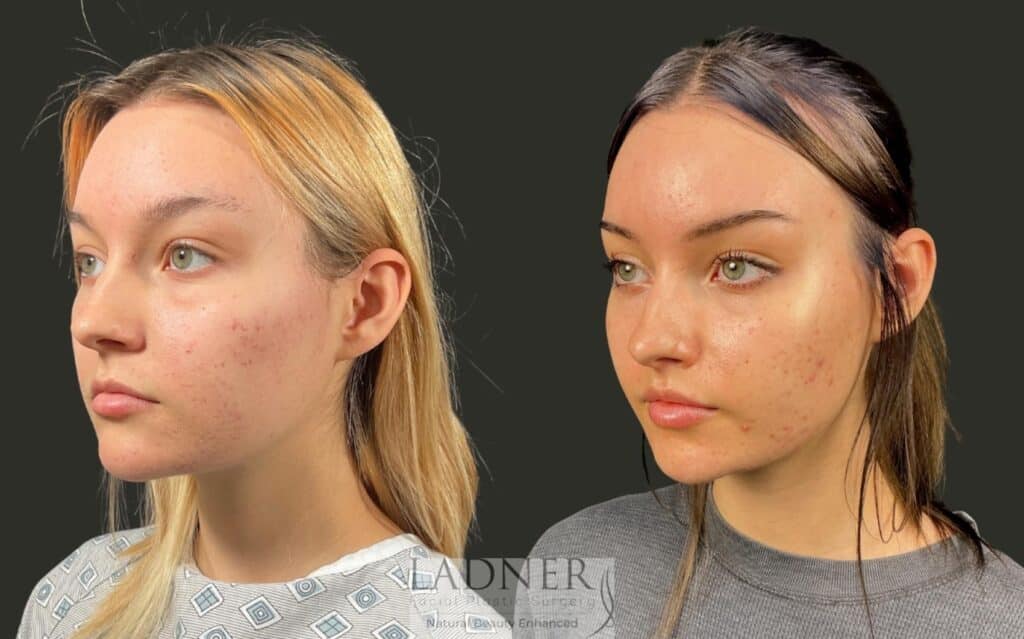 Before and After Image: Lip Lift - left-front-oblique