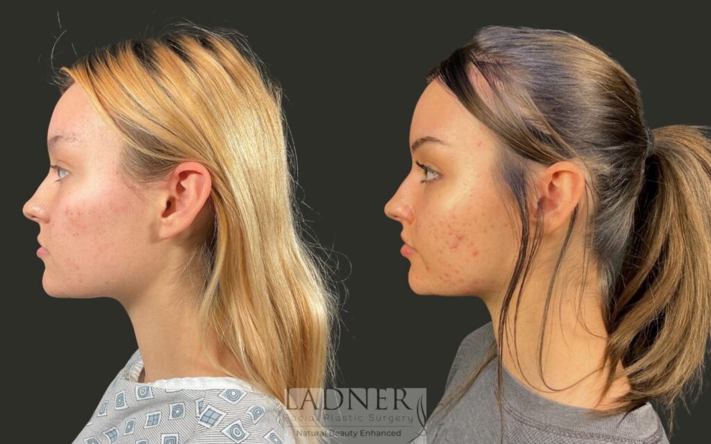 Before and After Image: Lip Lift - left-side