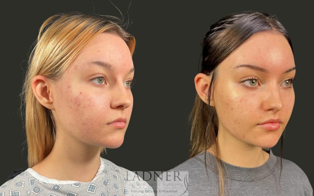 Before and After Image: Lip Lift - right-front-oblique