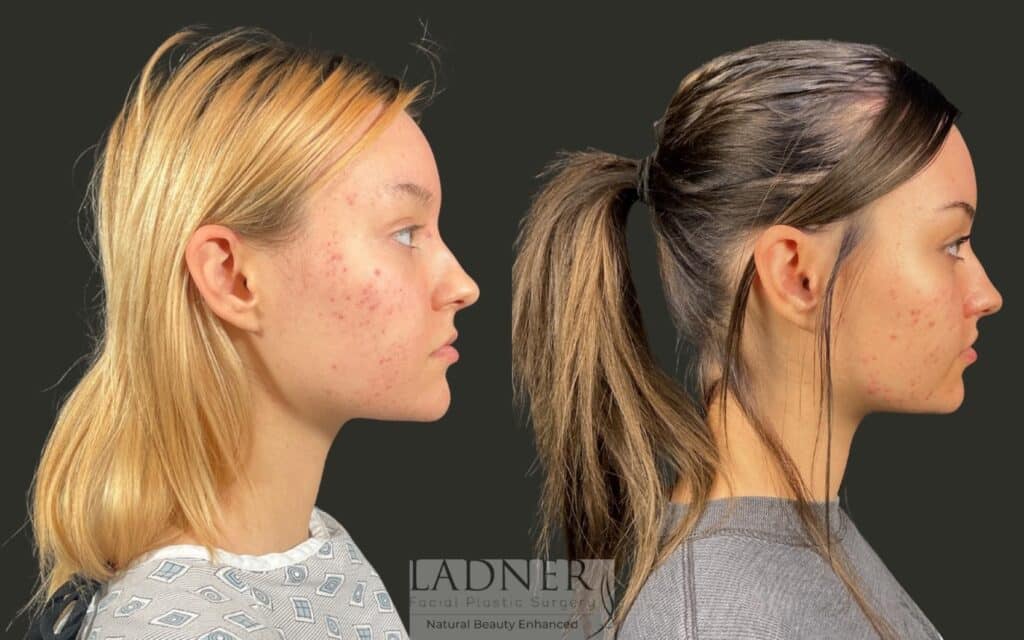 Before and After Image: Lip Lift - right-side