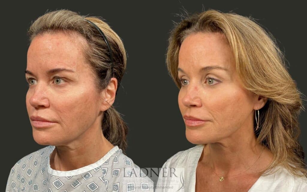 Before and After Image: Brow Lift - left-front-oblique